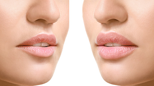 Lippenaufspritzen mit Hyaluron- vorher und nachher